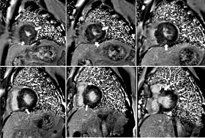 Preoperative myocardial fibrosis is associated with worse survival after alcohol septal ablation in patients with hypertrophic obstructive cardiomyopathy: A delayed enhanced cardiac magnetic resonance study